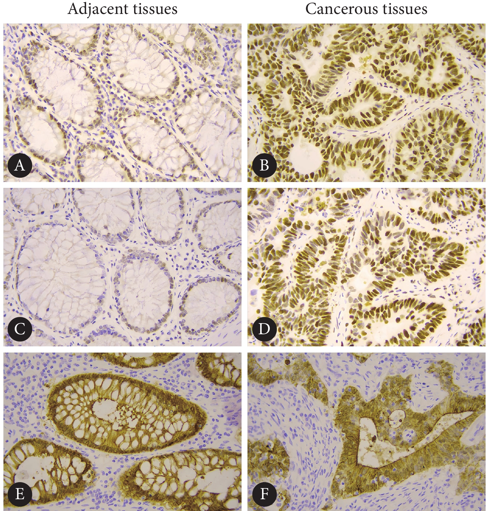 310例结肠癌患者组织MutS同系物和绒毛蛋白的表达与临床病理特征的相关性