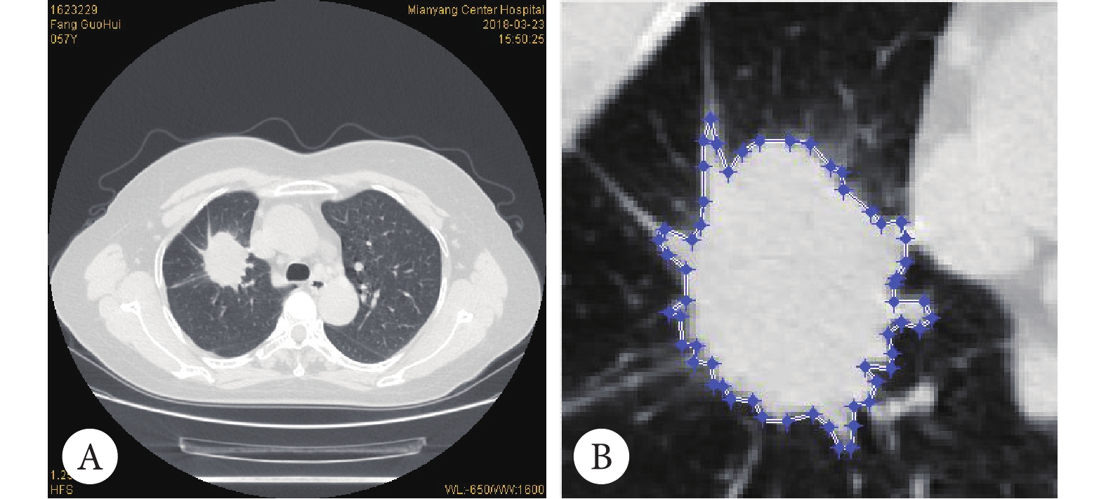 1例非小细胞肺癌患者的CT图（左）和病灶放置ROI示意图（右）