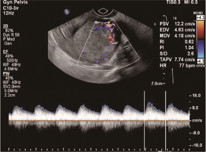 絨毛膜癌經靜脈超聲造影誤診為子宮肌壁間妊娠1例報告