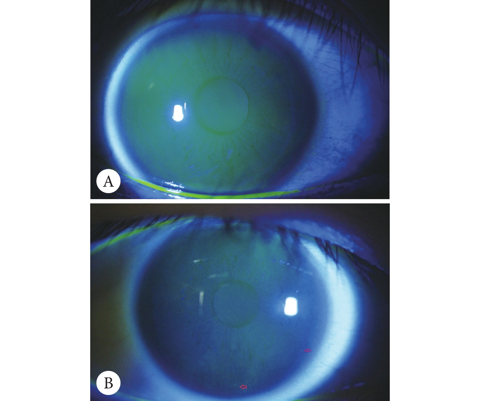 短期夜戴角膜塑形镜对成年近视患者泪膜的影响