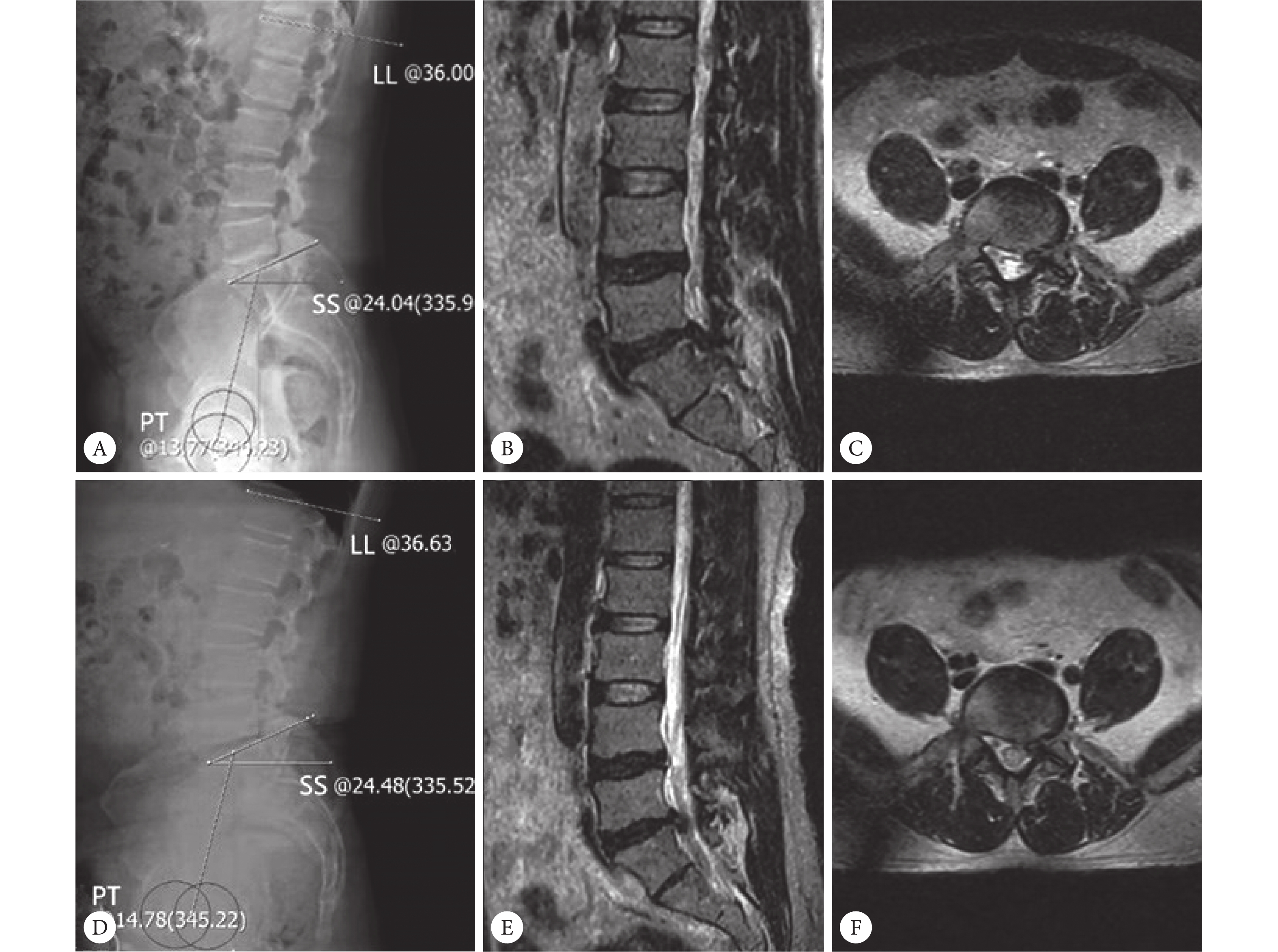 非吸收组1例46岁男性患者。入院时脊柱-骨盆矢状面形态（A）、矢状面MRI 