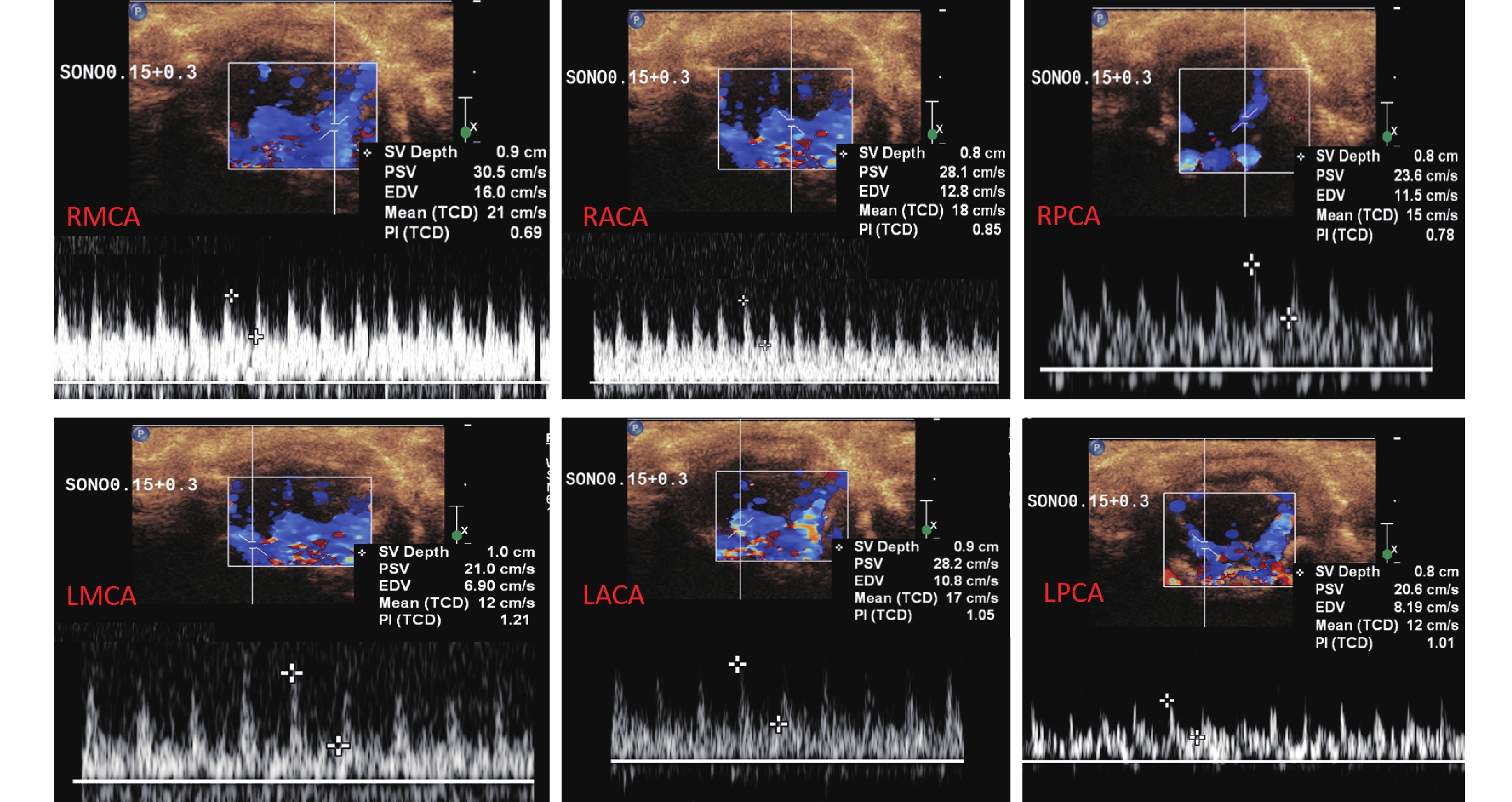 enhanced color doppler ultrasonography for