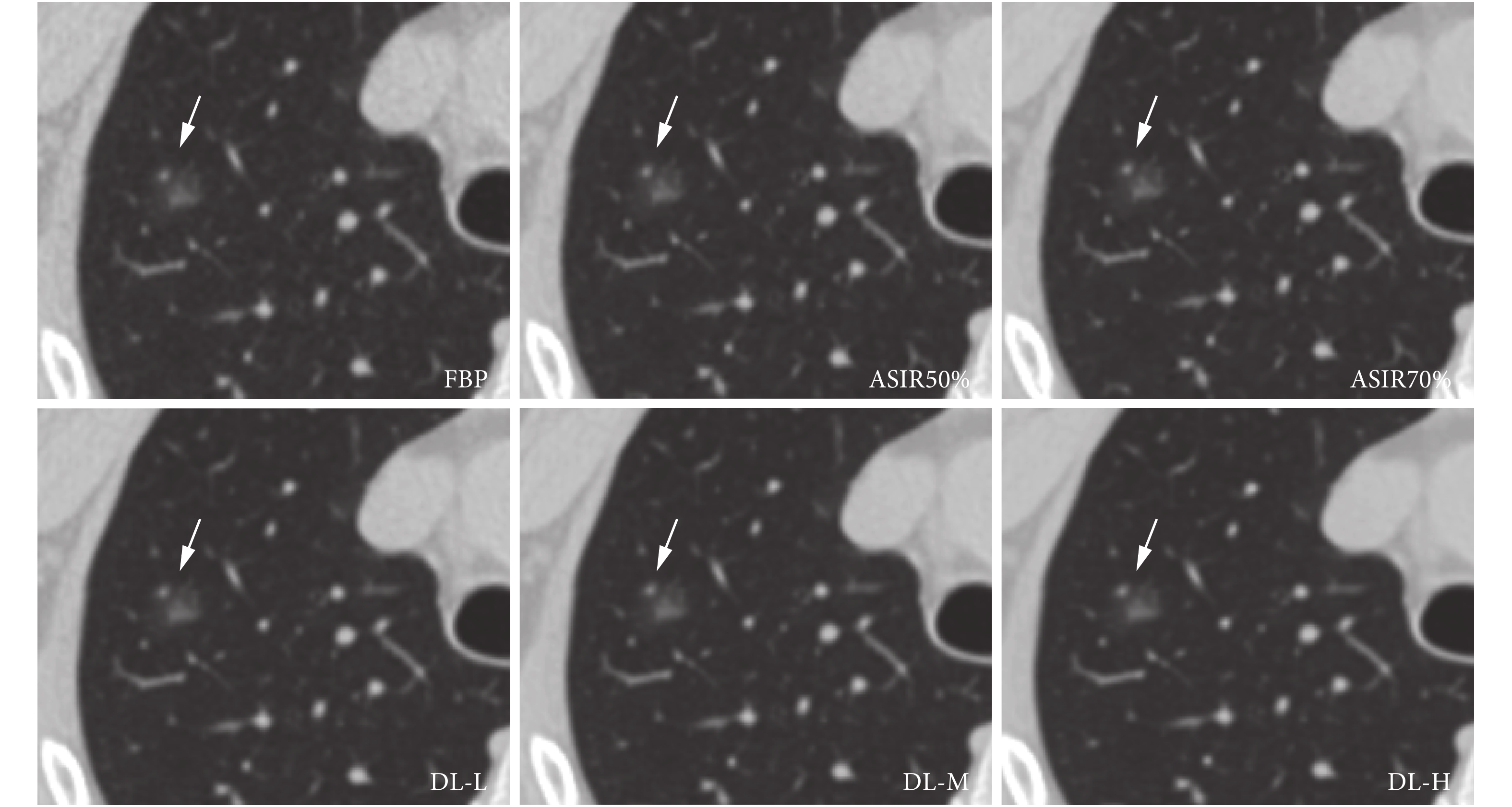 Noise Reduction Effect Of Deep-learning-based Image Reconstruction ...