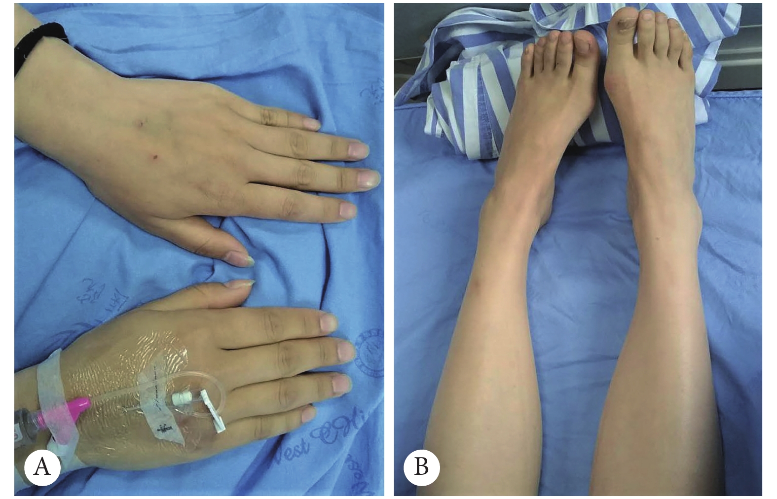 基底节区低灌注的偏侧萎缩偏侧帕金森综合征1例报告